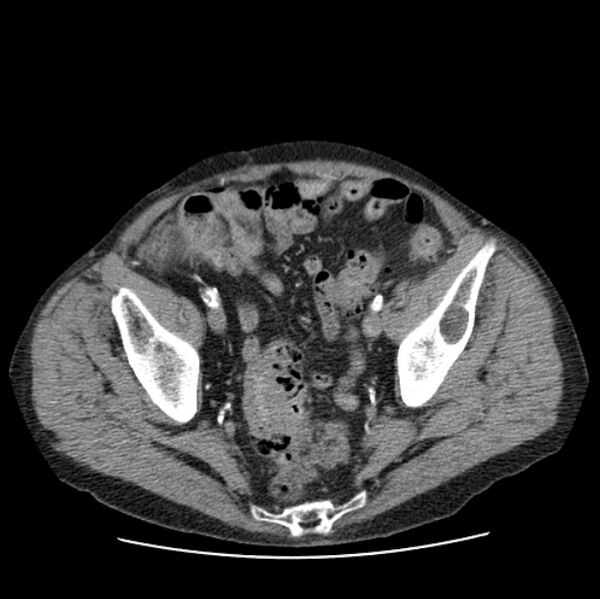 File:Autosomal dominant polycystic kidney disease (Radiopaedia 27851-28094 B 106).jpg