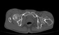 Avascular necrosis of the left hip (Radiopaedia 75068-86125 Axial bone window 70).jpg