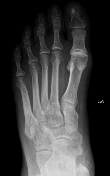 File:Avulsion fracture of the 5th metatarsal styloid - pseudo-Jones fracture (Radiopaedia 62857-71228 Frontal 1).PNG
