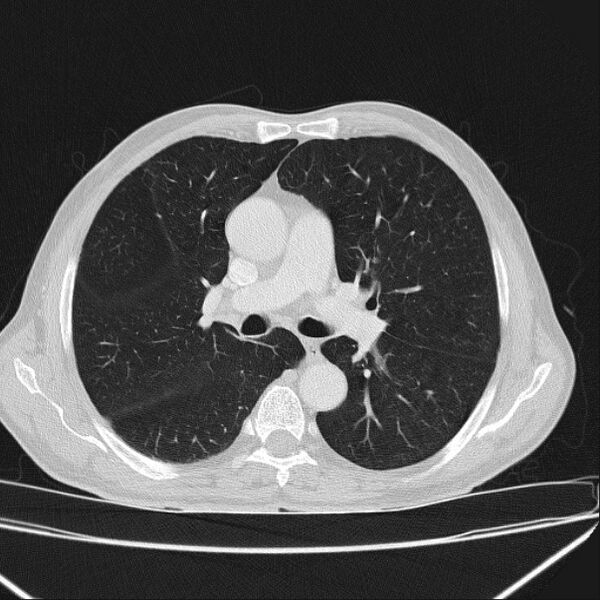 File:Azygos lobe (Radiopaedia 38259-40275 Axial lung window 36).jpg