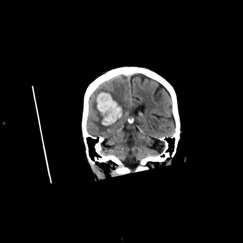 Basal ganglia hemorrhage (Radiopaedia 58350-65473 Coronal non-contrast 24).jpg