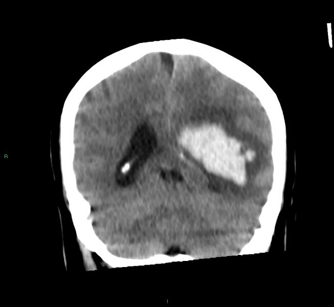 File:Basal ganglia hemorrhage (Radiopaedia 58759-65981 Coronal non-contrast 28).jpg