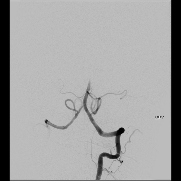 File:Basilar tip thrombus with endovascular clot retrieval (Radiopaedia 46320-50726 B 7).png