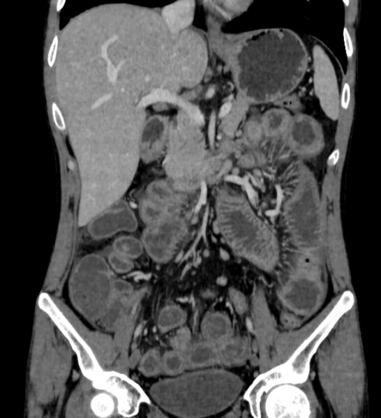 File:Behçet's disease- abdominal vasculitis (Radiopaedia 55955-62570 B 24).jpg