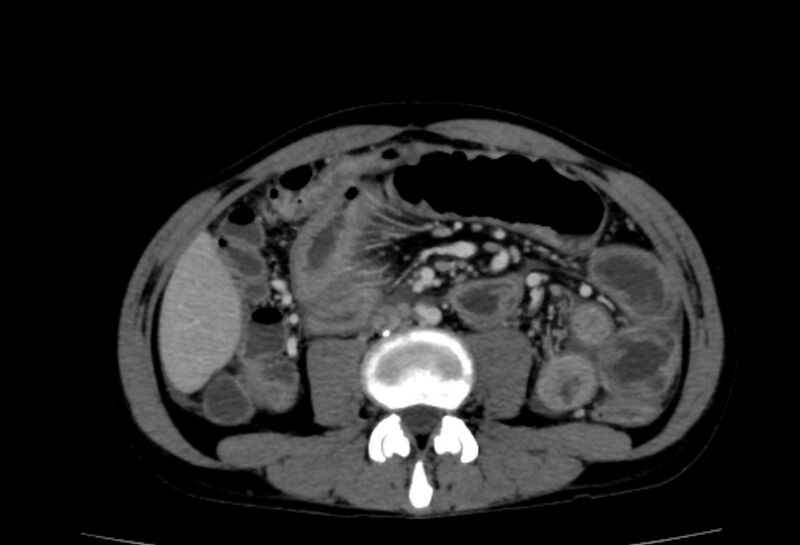 File:Behçet's disease. abdominal vasculitis (Radiopaedia 55955-62570 Axial 21).jpg