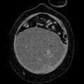 Benign leiomyoma with hydropic features (Radiopaedia 89250-106130 B 31).jpg