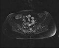 Bicornuate bicollis uterus (Radiopaedia 61626-69616 Axial PD fat sat 11).jpg