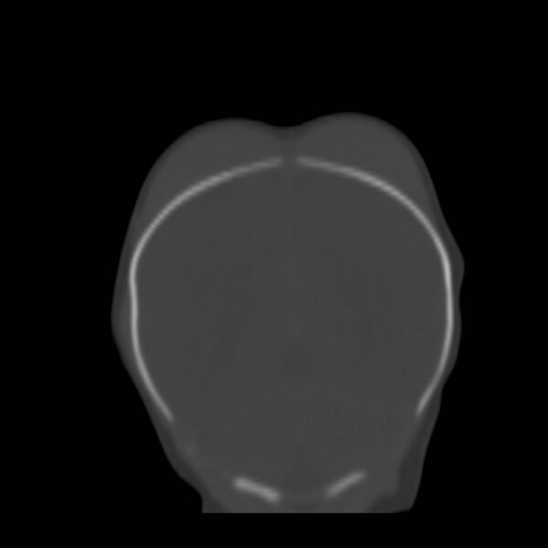 File:Bilateral cephalohematomas and subdural hematomas (Radiopaedia 26778-26929 Coronal bone window 23).jpg