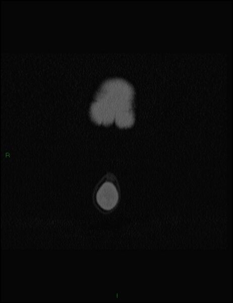 File:Bilateral frontal mucoceles (Radiopaedia 82352-96454 Coronal 5).jpg