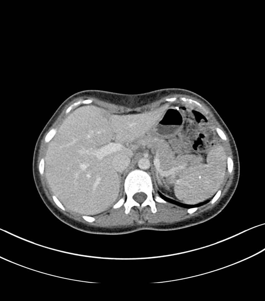 Bilateral kidney malrotation (Radiopaedia 72227-82749 A 1).jpg