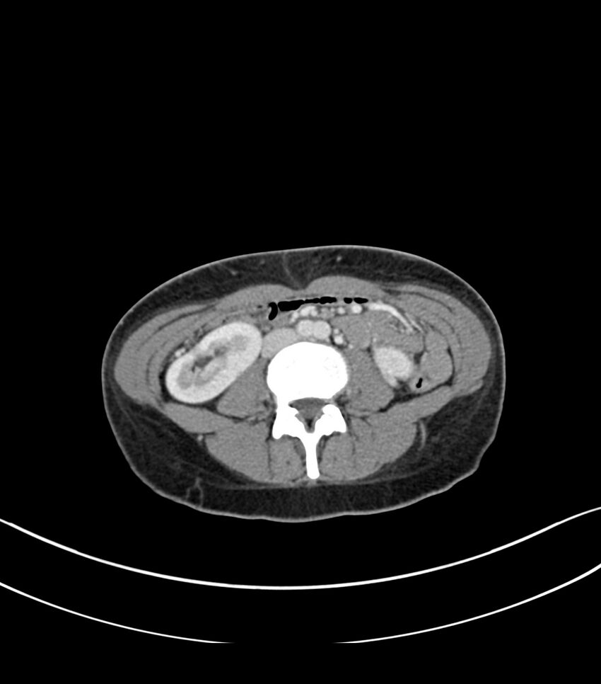 Bilateral kidney malrotation (Radiopaedia 72227-82749 A 36).jpg