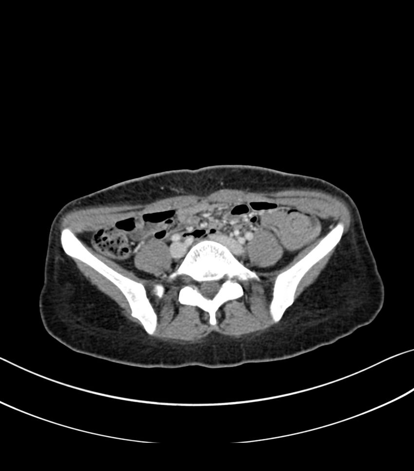 Bilateral kidney malrotation (Radiopaedia 72227-82749 A 49).jpg