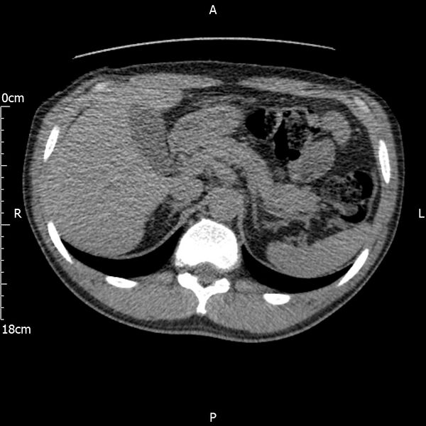 File:Bilateral medullary nephrocalcinosis with ureteric calculi (Radiopaedia 71269-81569 Axial non-contrast 25).jpg
