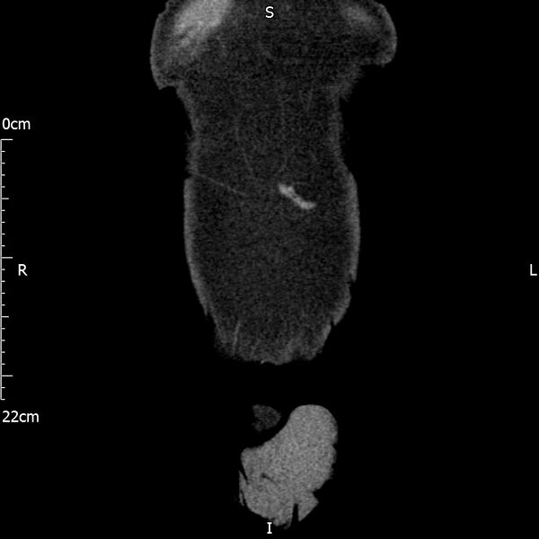 File:Bilateral medullary nephrocalcinosis with ureteric calculi (Radiopaedia 71269-81569 Coronal non-contrast 5).jpg