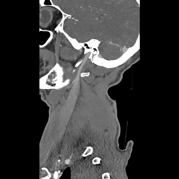 File:Bilateral perched facets with cord injury (Radiopaedia 45587-49713 B 4).jpg