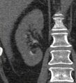 Bile leak from accessory duct(s) of Luschka post cholecystectomy (Radiopaedia 40736-43389 B 53).jpg