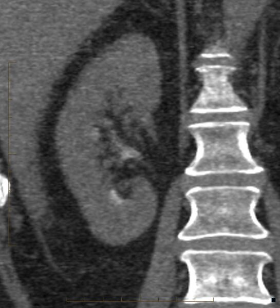 File:Bile leak from accessory duct(s) of Luschka post cholecystectomy (Radiopaedia 40736-43389 B 53).jpg