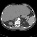 Biliary necrosis - liver transplant (Radiopaedia 21876-21845 A 13).jpg
