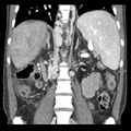 Biliary necrosis - liver transplant (Radiopaedia 21876-21846 C 32).jpg