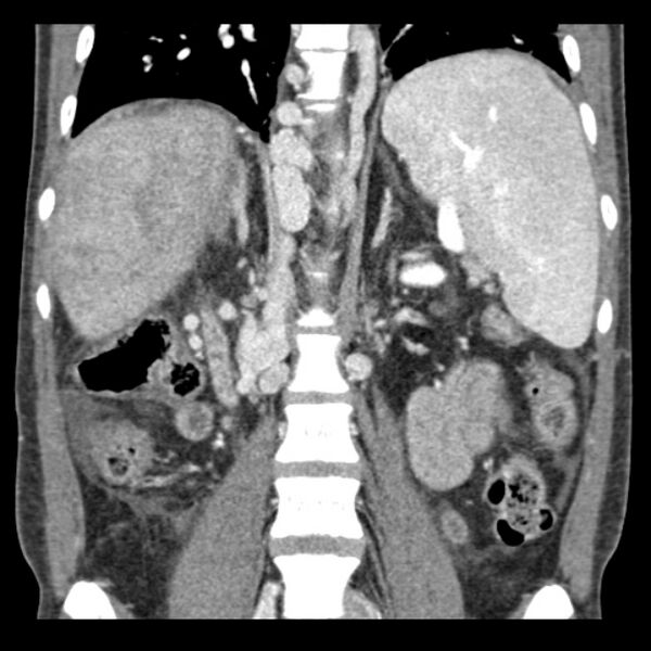 File:Biliary necrosis - liver transplant (Radiopaedia 21876-21846 C 32).jpg