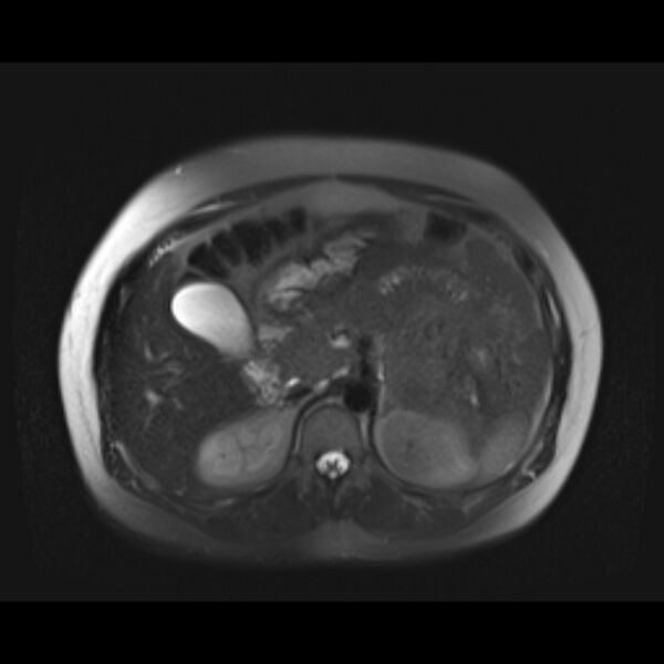 File:Bilobed placenta accreta (Radiopaedia 69648-79591 Axial T2 fat sat 7).jpg