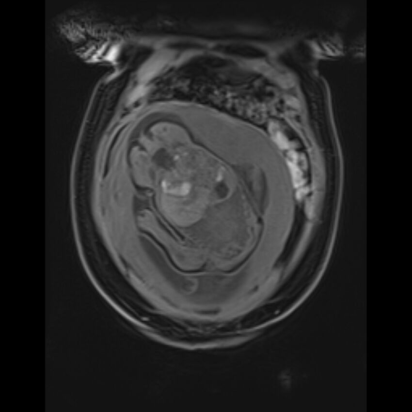 Bilobed placenta accreta (Radiopaedia 69648-79591 Coronal T1 vibe 39).jpg