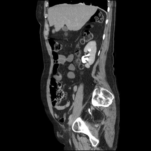 File:Bladder tumor detected on trauma CT (Radiopaedia 51809-57609 E 53).jpg