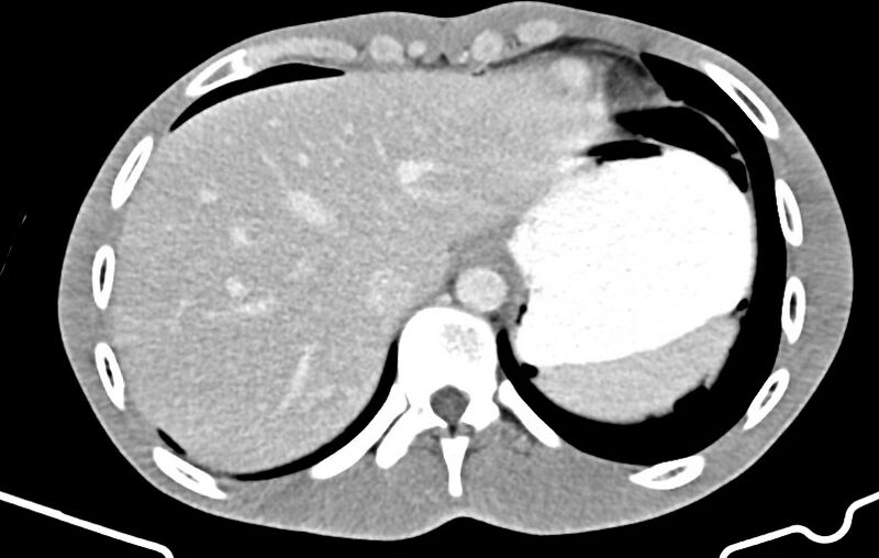 File:Blunt injury to the small bowel (Radiopaedia 74953-85987 A 9).jpg
