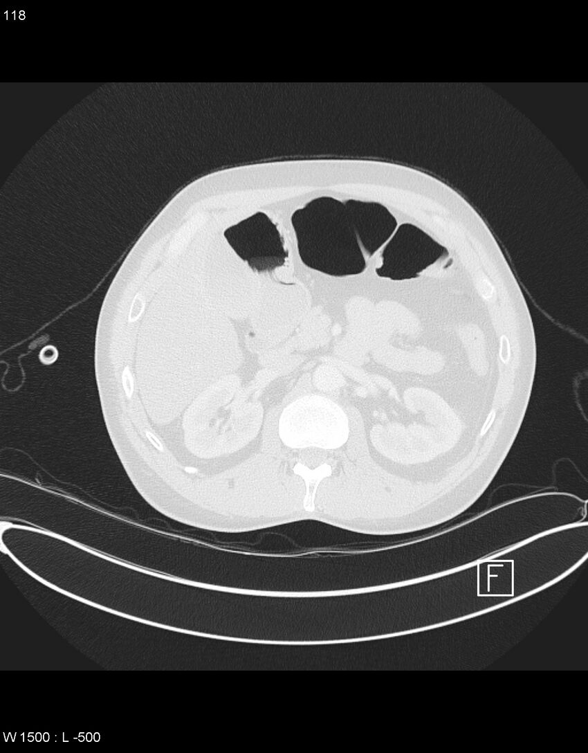 Boerhaave syndrome with tension pneumothorax (Radiopaedia 56794-63605 Axial lung window 58).jpg