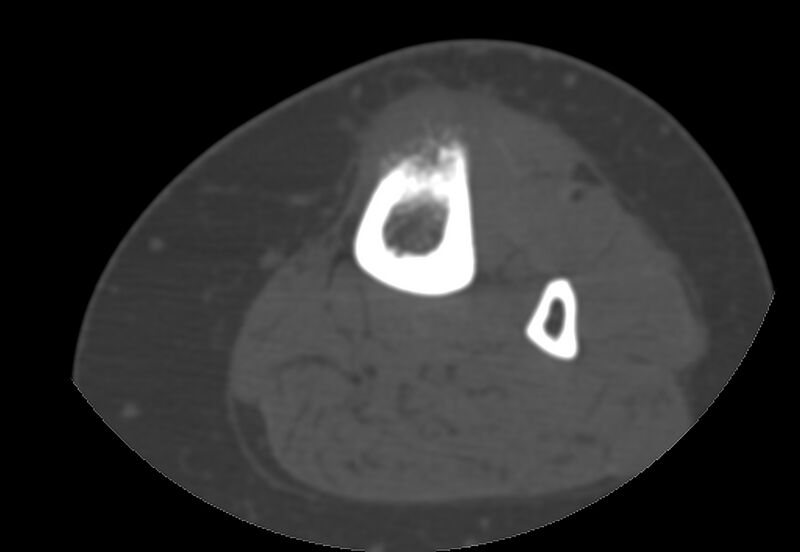 File:Bone metastasis - tibia (Radiopaedia 57665-64609 Axial bone window 101).jpg