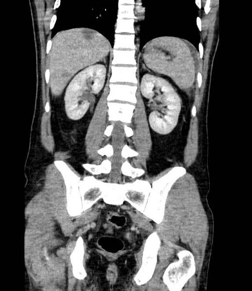 File:Bowel obstruction from colon carcinoma (Radiopaedia 22995-23028 C 53).jpg