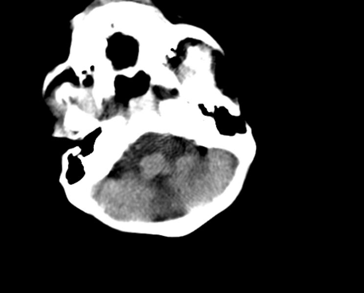 File:Brachycephaly (bi-coronal and bi-lambdoid synostosis) (Radiopaedia 55048-61413 Axial non-contrast 10).jpg