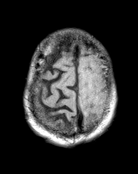 File:Brain abscess with dual rim sign (Radiopaedia 87566-103938 Axial T1 22).jpg