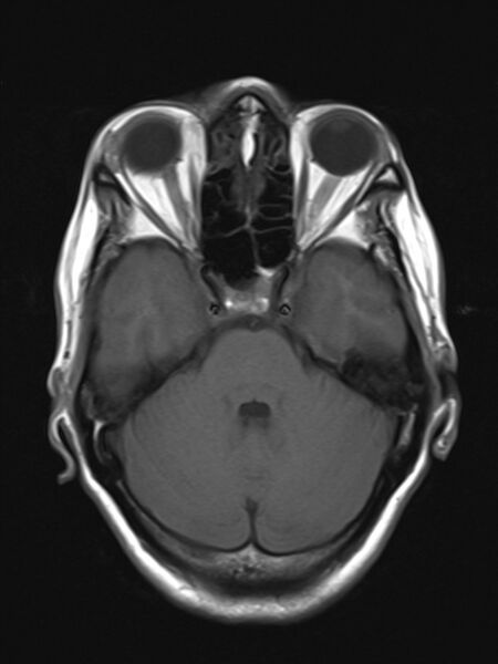 File:Brain metastasis as initial presentation of non-small cell lung cancer (Radiopaedia 65122-74126 Axial T1 7).jpg