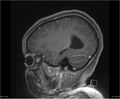 Brainstem glioma (Radiopaedia 21819-21775 D 32).jpg