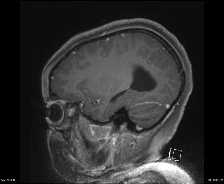 File:Brainstem glioma (Radiopaedia 21819-21775 D 32).jpg