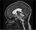 Brainstem glioma (Radiopaedia 21819-21775 Sagittal T2 15).jpg