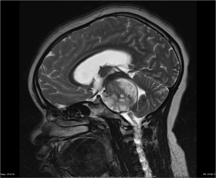 File:Brainstem glioma (Radiopaedia 21819-21775 Sagittal T2 15).jpg