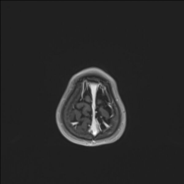 File:Brainstem glioma (Radiopaedia 70548-80674 Axial T1 C+ 145).jpg