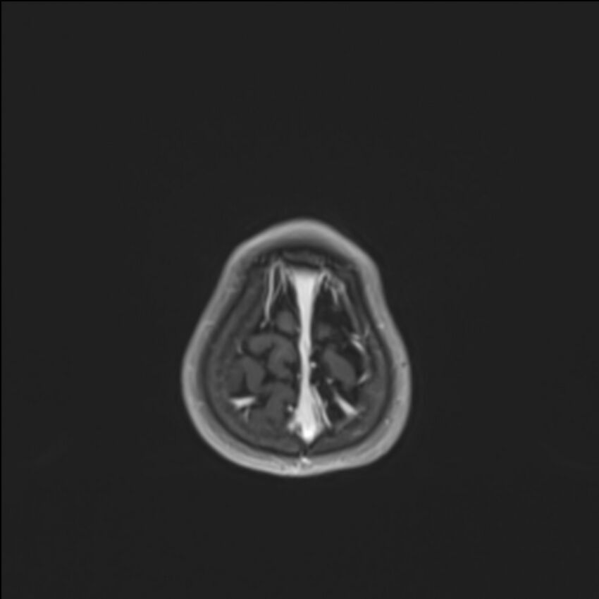 Brainstem glioma (Radiopaedia 70548-80674 Axial T1 C+ 145).jpg