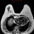Breast carcinoma (multicentric multifocal in mammary Paget disease) (Radiopaedia 50966-56512 Axial T1 3).jpg