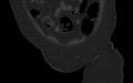 Breast carcinoma with pathological hip fracture (Radiopaedia 60314-67993 Coronal bone window 37).jpg