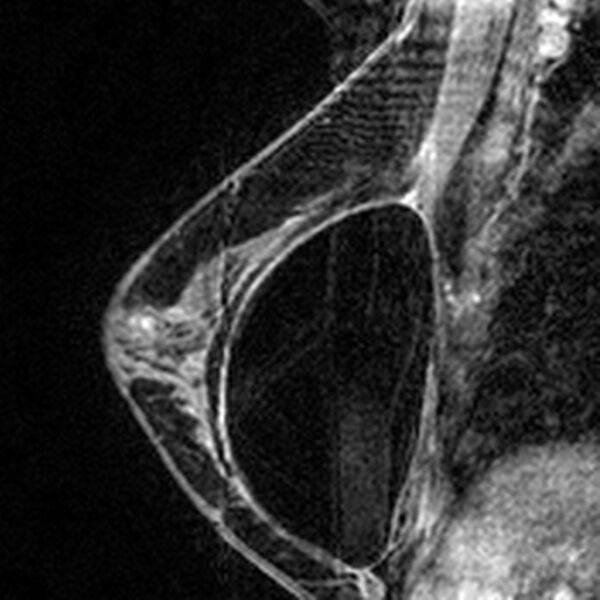 File:Breast implants - MRI (Radiopaedia 26864-27035 Sagittal T2 107).jpg