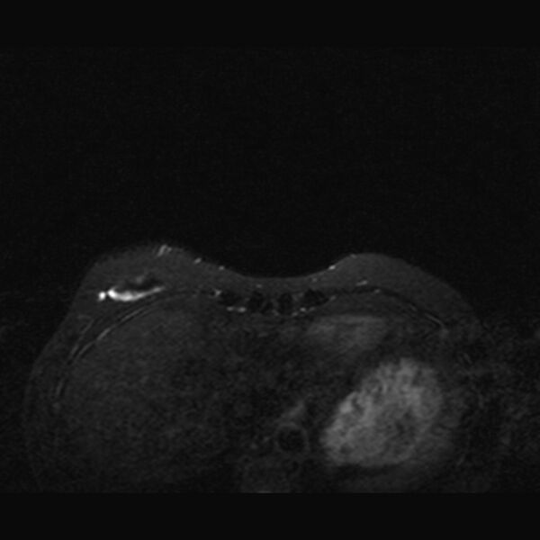 File:Breast implants - MRI (Radiopaedia 26864-27035 T2 SPAIR 6).jpg