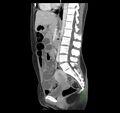 Broad ligament hernia (Radiopaedia 63260-71832 C 27).jpg