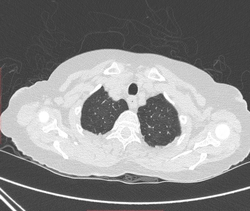 Bronchiectasis (Radiopaedia 72693-83293 Axial lung window 10).jpg