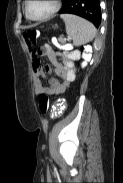 File:Brown tumors compressing the spinal cord (Radiopaedia 68442-77988 F 43).jpg