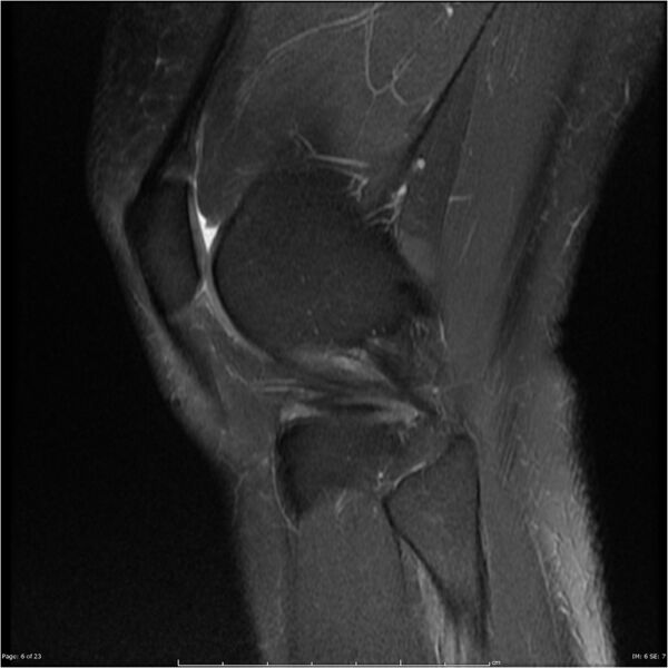 File:Bucket handle tear - lateral meniscus (Radiopaedia 7246-8187 Sagittal T2 fat sat 6).jpg