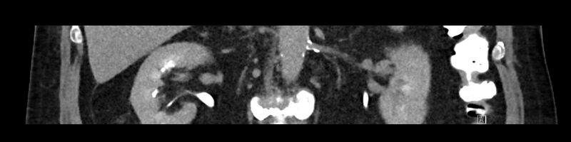 File:Buried bumper syndrome - gastrostomy tube (Radiopaedia 63843-72575 Coronal 22).jpg