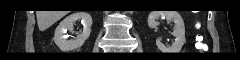 File:Buried bumper syndrome - gastrostomy tube (Radiopaedia 63843-72575 Coronal Inject 63).jpg